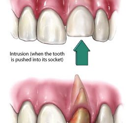 What Should I Do If My Tooth Gets Knocked Out?