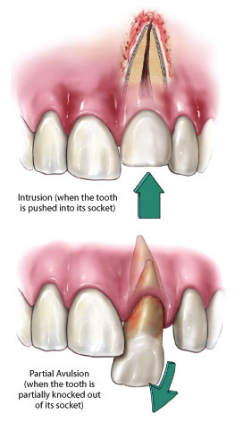 What Should I Do If My Tooth Gets Knocked Out?